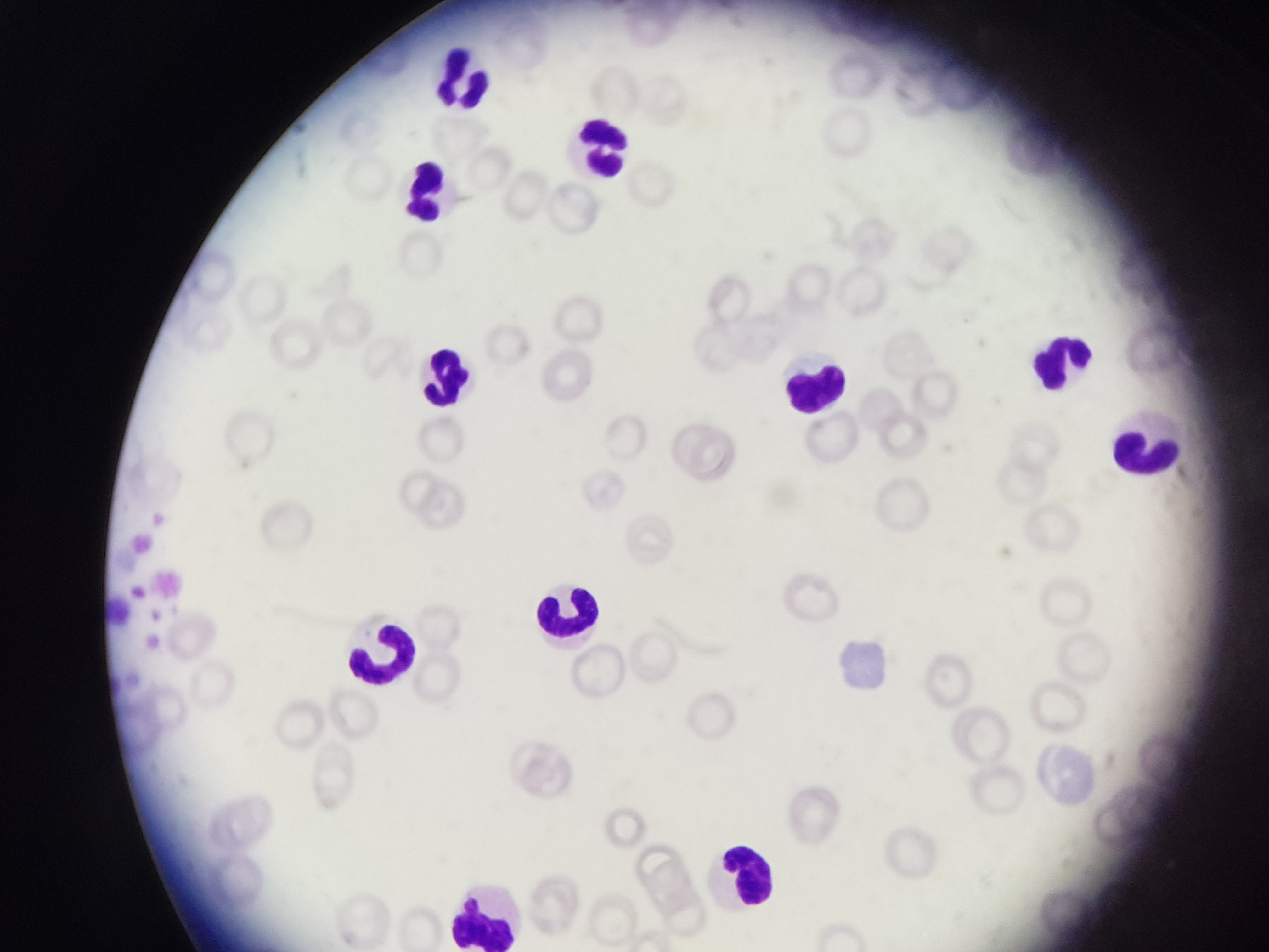 Neutrofilia